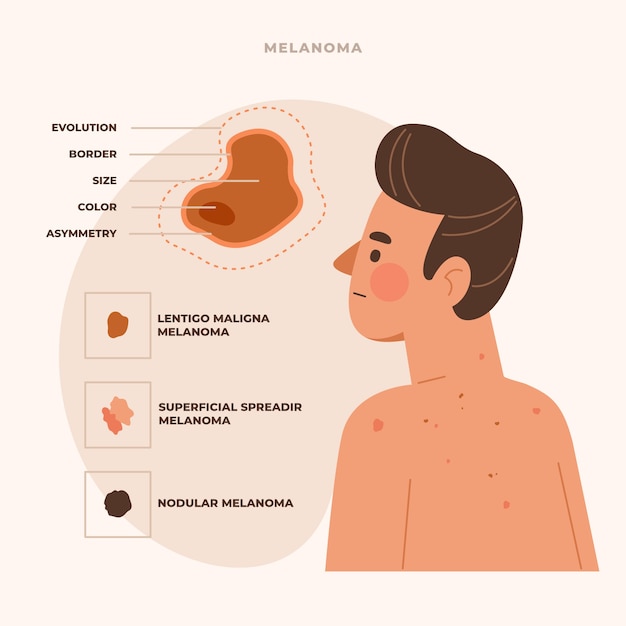 Infografica sul melanoma dal design piatto disegnato a mano