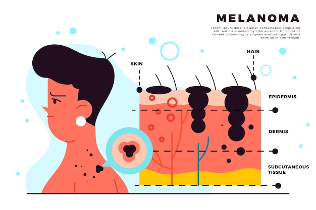 Hand drawn flat design melanoma infographic