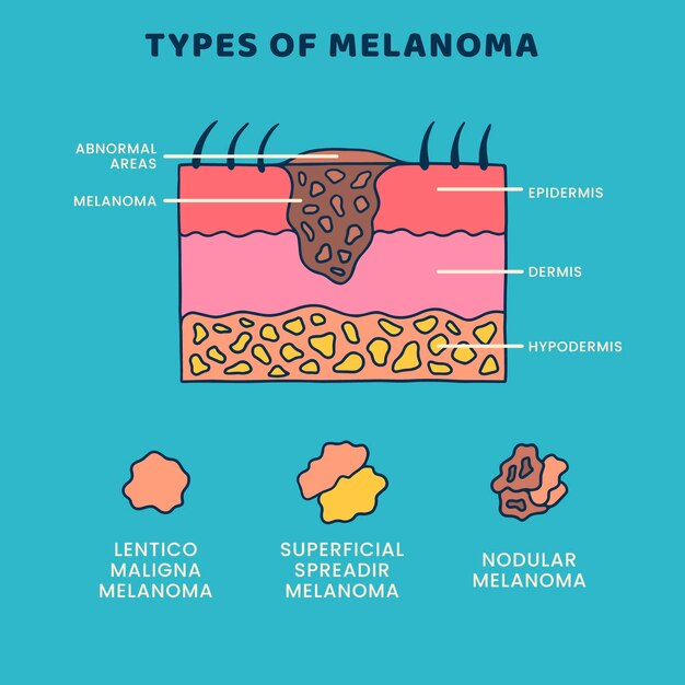 Infografica sul melanoma dal design piatto disegnato a mano