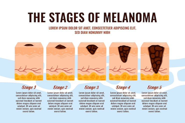 Free Vector hand drawn flat design melanoma infographic