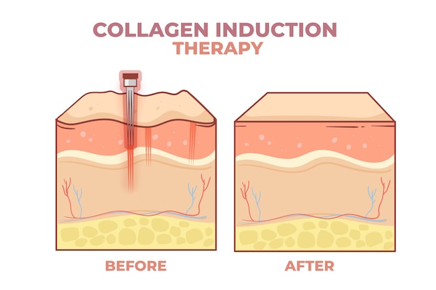 Hand drawn flat design micro needling infographic