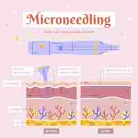 무료 벡터 손으로 그린 평면 디자인 microneedling infographic