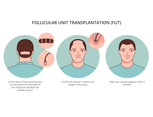 Hand drawn hair transplant infographic