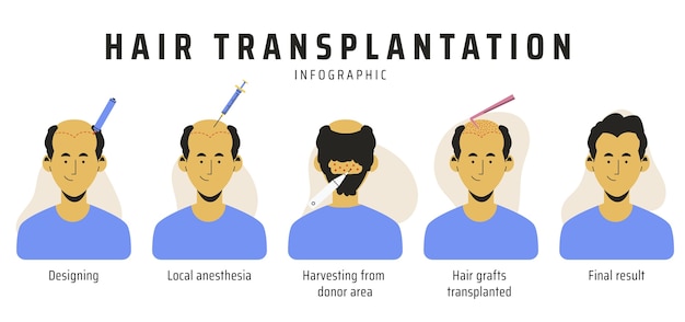 Vettore gratuito infografica sul trapianto di capelli disegnata a mano