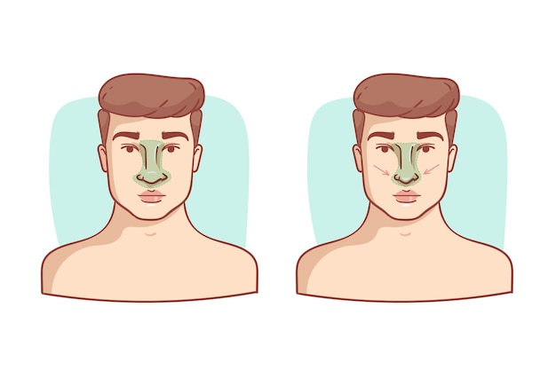 Hand drawn rhinoplasty illustration