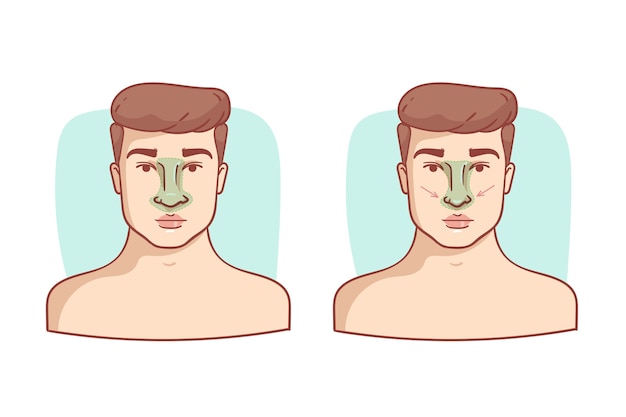 Free vector hand drawn rhinoplasty illustration