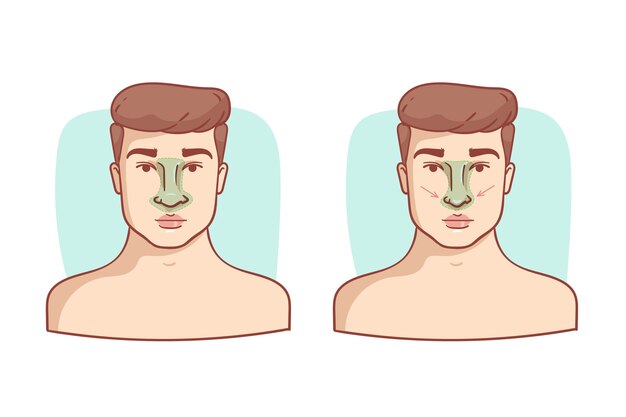hand drawn rhinoplasty illustration