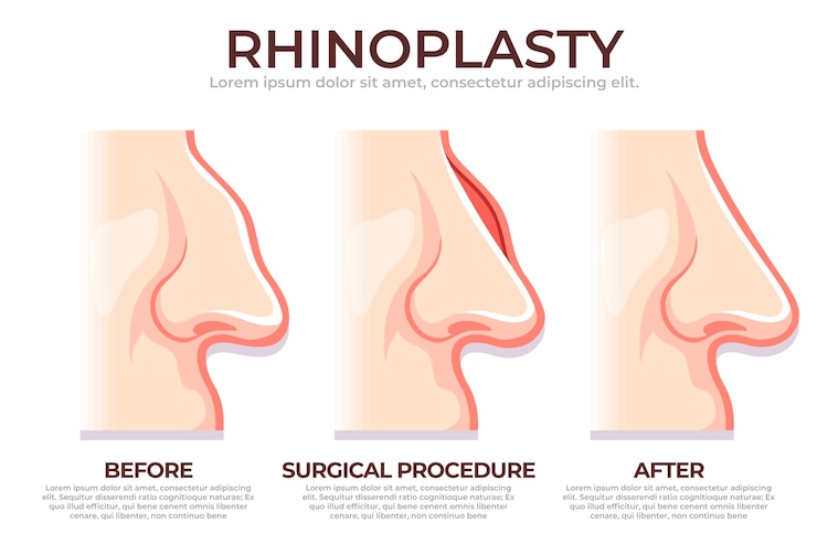 Free Vector hand drawn rhinoplasty infographic
