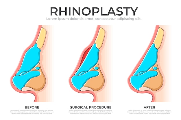 Vettore gratuito infografica di rinoplastica disegnata a mano