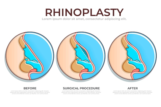 Hand drawn rhinoplasty infographic