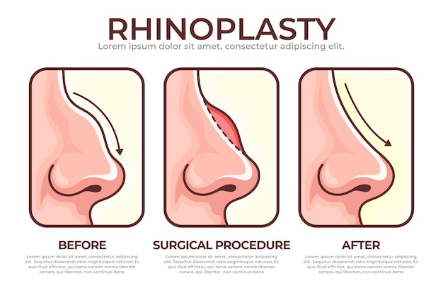 Free vector hand drawn rhinoplasty infographic