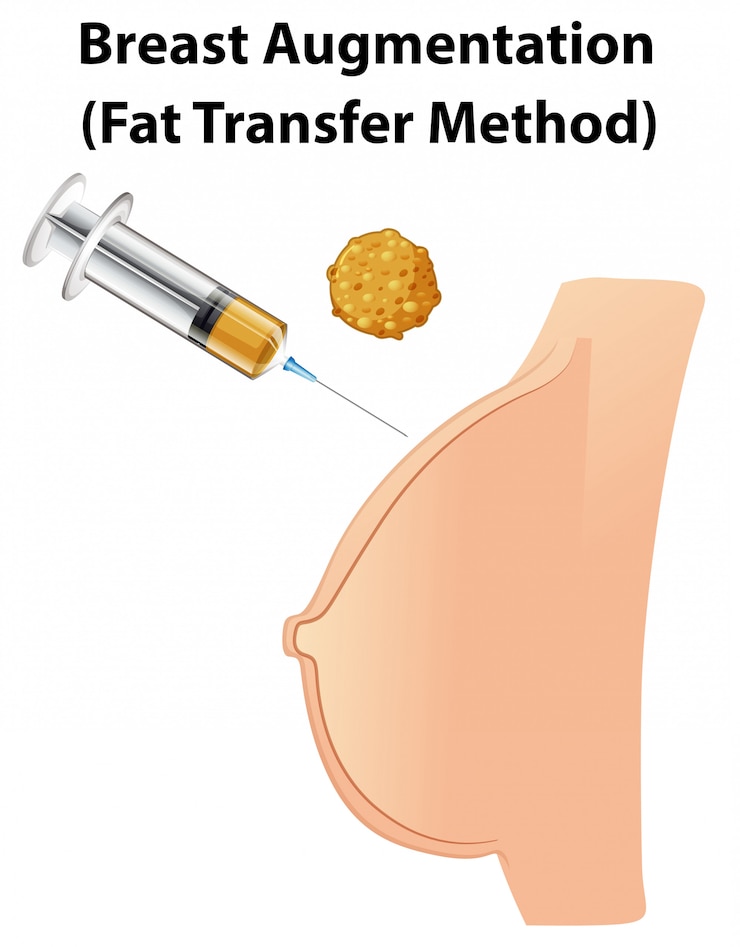 無料Vector 人体解剖学的乳房増強