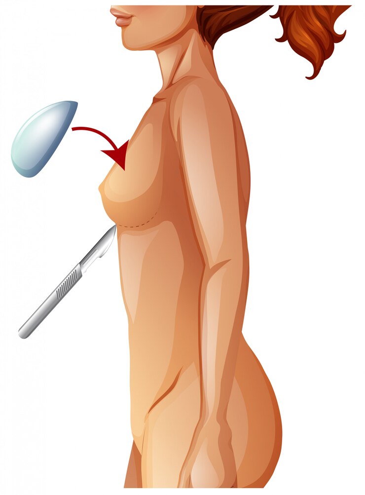 Free Vector a human anatomy breast augmentation
