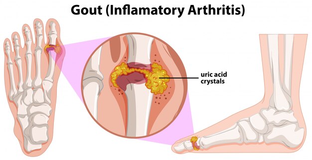 A Human Anatomy of Gout