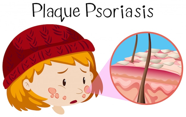 Free vector human anatomy of plaque psoriasis