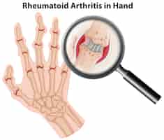 Free vector human anatomy rheumatoid arthritis in hand