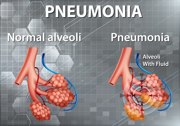 Anatomia umana che mostra la polmonite