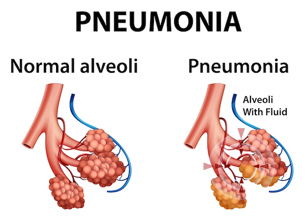 Vettore gratuito anatomia umana che mostra la polmonite