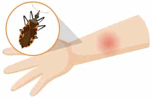 Бесплатное векторное изображение Человеческая рука распухла от укуса поцелуйного жука