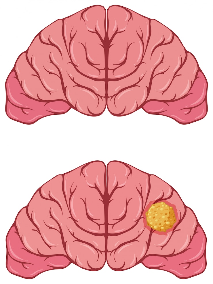 Free Vector human brain with cancer