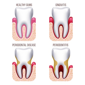 ヒト​の​歯茎​疾患​、​歯肉​の​出血​。​歯​疾患​予防​歯科​、​口腔​ケア