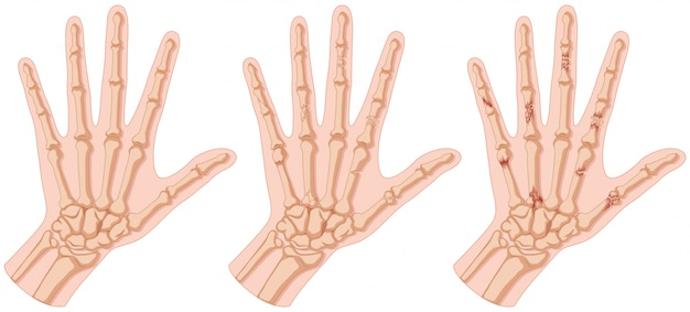 Free vector human hands with bone fracture illustration