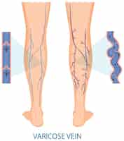 Free vector human legs with varicose vein