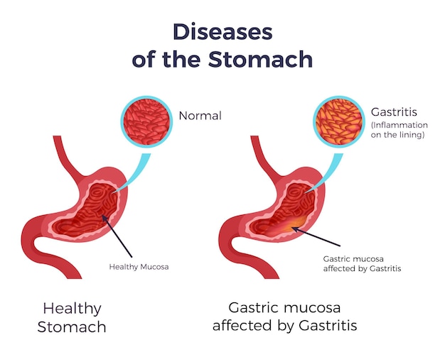 Human normal stomach compared to gastritis affected swollen inflamed mucosa lining flat set infographic poster