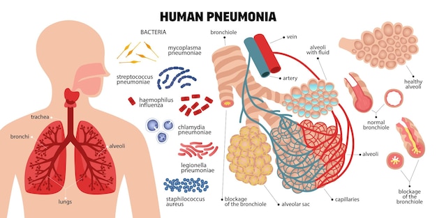 感染性細菌の人間の肺の部分のアイコンとポインター ベクトル図とテキスト キャプションと人間の肺炎組成