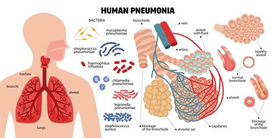 Бесплатное векторное изображение Композиция пневмонии человека с иконками инфекционных бактерий частей легких человека и текстовыми подписями с векторной иллюстрацией указателей