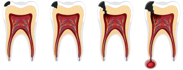 Free vector human in the stages of tooth decay