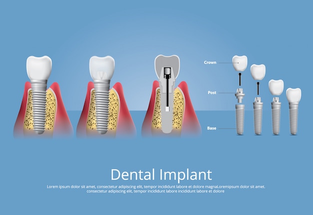 Human teeth and Dental implant Vector Illustration