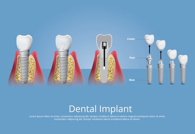 인간의 치아와 치과 임플란트 벡터 일러스트 레이 션