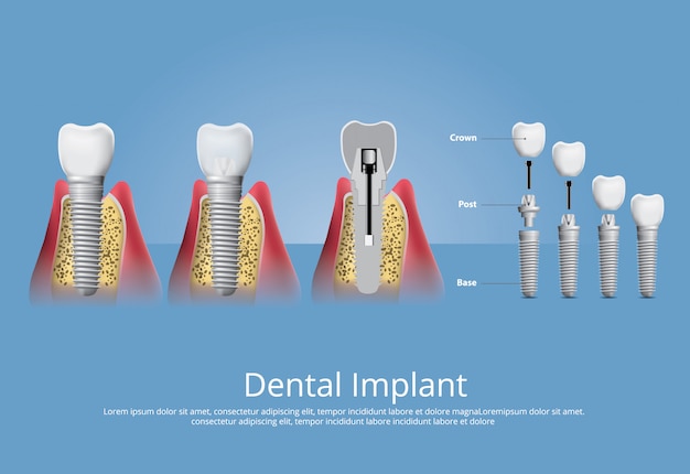 Человеческие зубы и зубные имплантаты векторные иллюстрации