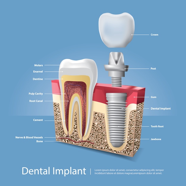 Vettore gratuito illustrazione di vettore di denti umani e impianto dentale