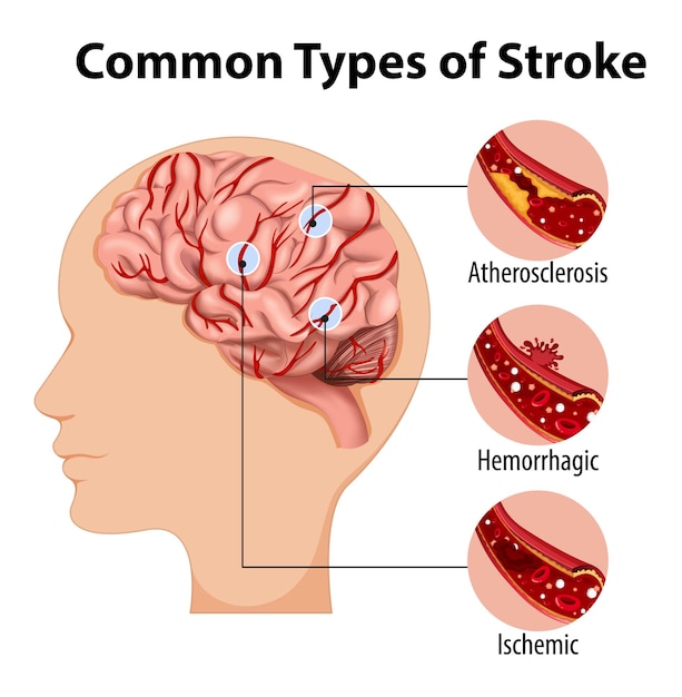 Human with common types of stroke