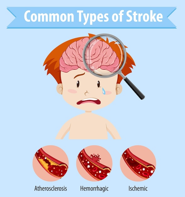 Free vector human with common types of stroke