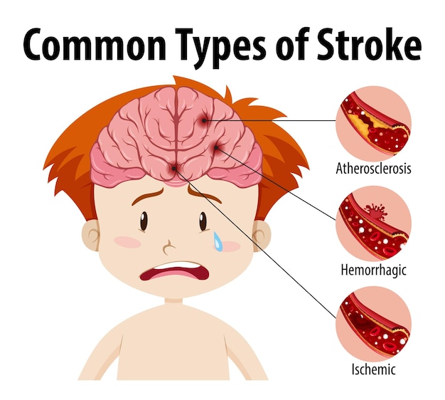 Free vector human with common types of stroke