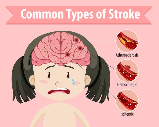 Free vector human with common types of stroke