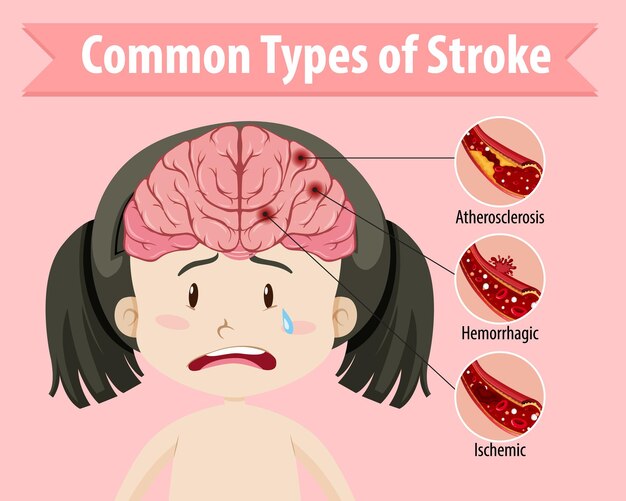 Human with common types of stroke