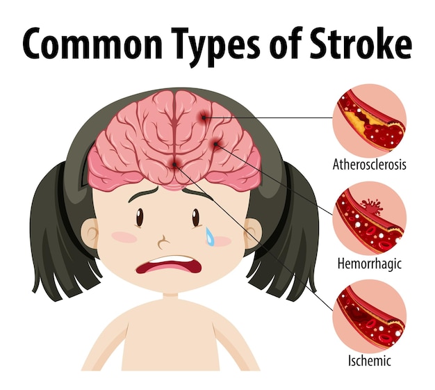 Free vector human with common types of stroke