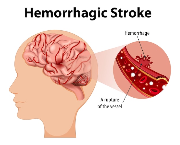 Free vector human with hemorrhagic stroke