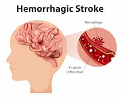 Vettore gratuito umano con ictus emorragico