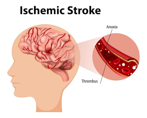 Vettore gratuito umano con ictus ischemico