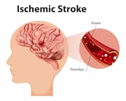 Vettore gratuito umano con ictus ischemico