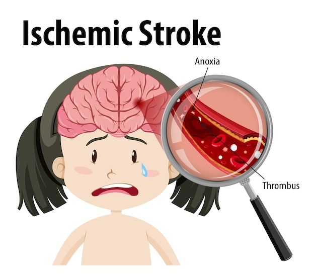 Free vector human with ischemic stroke
