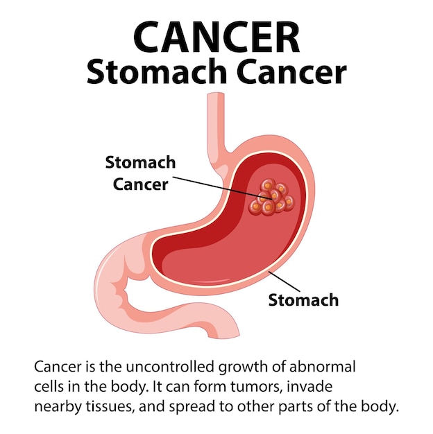 Vettore gratuito cancro allo stomaco infografico illustrato e crescita cellulare anormale