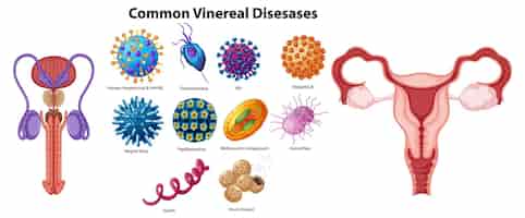 Free vector illustration of common venereal diseases