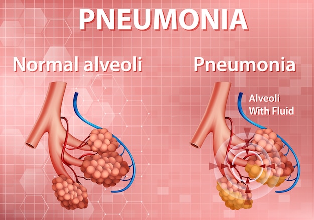 Illustrazione di anatomia umana che mostra la polmonite