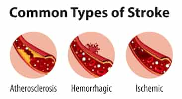 Free vector infographic of common types of stroke